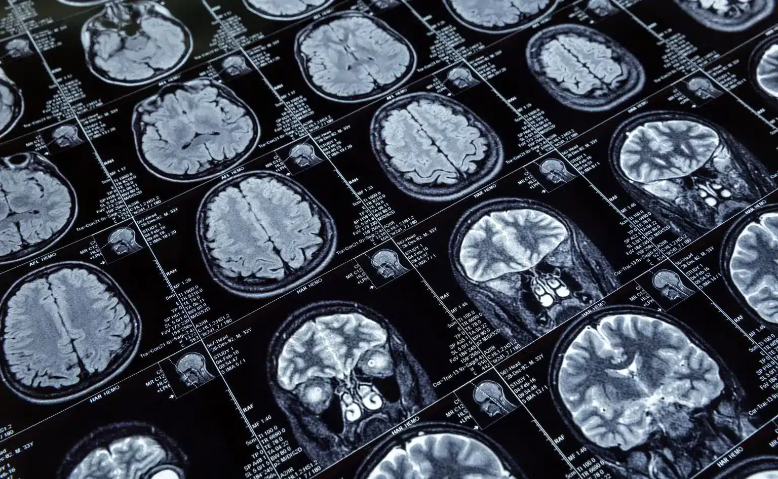 Resultados de una resonancia magnética cerebral, como ilustración de la IA para interpretar resonancias